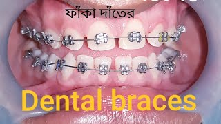 Dental orthodontic braces treatment Dhaka by Dr Anwar ফাঁকা দাঁতের ব্রেসেস চিকিৎসা। [upl. by Niessuh554]