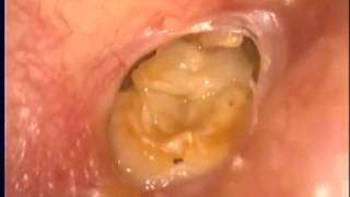 中耳炎 珍珠瘤 right COM RO cholesteatoma neartotal perforation of ear drum [upl. by Einnob]