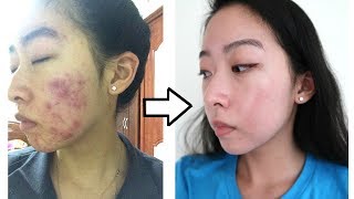 How I Cleared My Acne with ONE Product NO ACCUTANE [upl. by Chaffee]