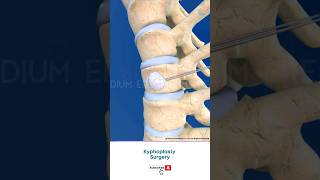 Spine Fracture Kyphoplasty ↪ 3D Medical Animation Shorts Kyphoplasty KyphoplastySurgery Spine [upl. by Mamoun]