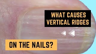 What Causes Vertical Ridges on The Nails [upl. by Ahsenal]