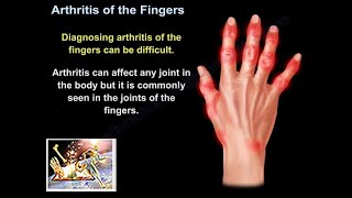 Arthritis Of The Fingers  Everything You Need To Know  Dr Nabil Ebraheim [upl. by Nnaid909]