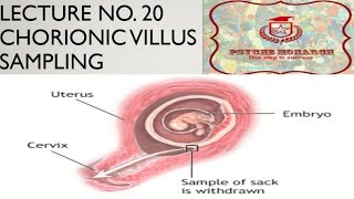 chorionic villus sampling in urdu [upl. by Aivekahs398]