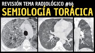 Revisión de Tema 66 Semiología torácica [upl. by Ace921]