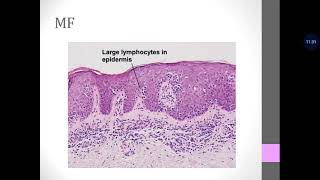 Basic Dermatopathology 19 Vascular  Lymphoid  Fibrohistiocytic Tumors [upl. by Hamburger]