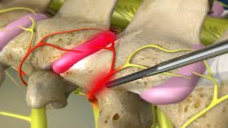 What is Cervical Facet Radiofrequency Neurotomy [upl. by Iolenta11]