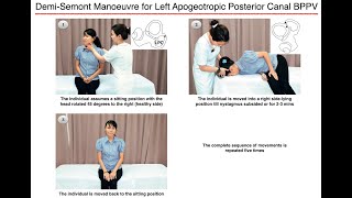 DemiSemont Manoeuvre for Left Apogeotropic Posterior Canal BPPV [upl. by Euqinommod]