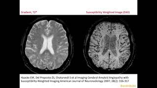 68 CAA Cerebral Amyloid micro Angiopathy vascular dementia micro bleeds superficial siderosis [upl. by Evad]