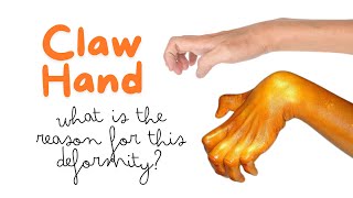 Claw hand is due to paralysis of what muscles Reason for clawing of hand handdeformity clawhand [upl. by Apthorp]