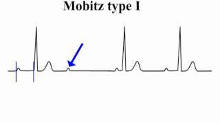 ECG Interpretation  AtrioVentricular Block [upl. by Ger]