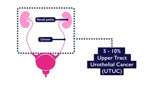 Upper Tract Urothelial Cancer [upl. by Xed]