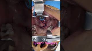 Speech Surgery to correct nasality in voice and depth by dr richardson [upl. by Heiner621]