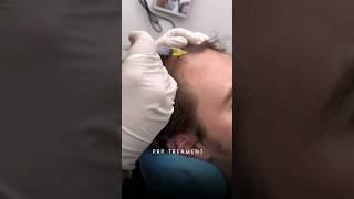 PRP Hair Treatment  Hair loss Treatment  PRPTreatment HairRestoration [upl. by Tyika200]