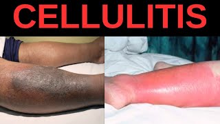 What is Cellulitis Symptoms Causes Treatment [upl. by Notelrac]