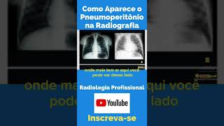 Como Aparece o Pneumoperitônio na Radiografia shorts tecnologoemradiologia tecnicosemradiologia [upl. by Yannodrahc995]