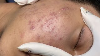 ACNE TREATMENT VU QUYNH MI Acne On Teens Cheek 2024 [upl. by Hurty265]