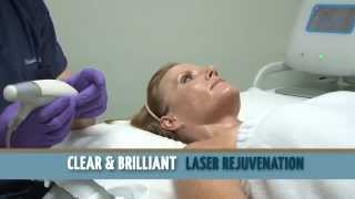 Clear  Brilliant Fractional Laser in Charlotte NC [upl. by Dnumsed125]