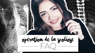 FAQ  OPÉRATION DE LA SCOLIOSE [upl. by Georgiana634]