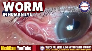 Ophthalmology  Worm in Human Eye Causes amp Extraction Process  Eye Parasite Removal [upl. by Aisyat]