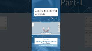 Clinical Indications Crossbite Part 1 [upl. by Secnarfyram]