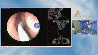 ERS London 2018 Andreas Leunig Frontal Sinus MasterClass Cadaveric Dissection [upl. by Nosraep]