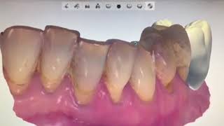 Cerec scan body on 3Shape dental studio [upl. by Donny]