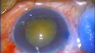 MSICS in Lens Induced Glaucomas [upl. by Schoening]