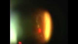 Eye Floater Treatment 3mm from Retina by Scott Geller MD [upl. by Aikemal983]