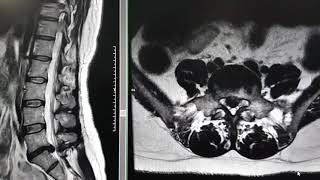 Como se ve una hernia discal en una resonanciaHernia discal L5S1 [upl. by Mook]