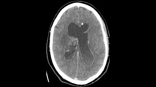 Ventriculitis  CT findings [upl. by Finny]