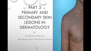 PRIMARY AND SECONDARY SKIN LESIONS CONFIGURATION AND DISTRIBUTION OF SKIN DISEASESeducation duet [upl. by Weywadt]