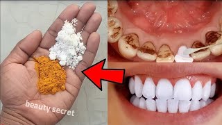 easy teeth whitening at home [upl. by Frederica879]