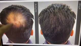 Real Result of Surminox hair regrowth solution in our patients Minoxidil 100 results Dr Animesh [upl. by Irehs]