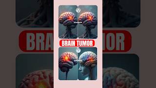 quotBrain Tumor Awareness Symptoms Diagnosis and Treatmentquot By OperationTheatreSKR BrainTumour [upl. by Desdemona]