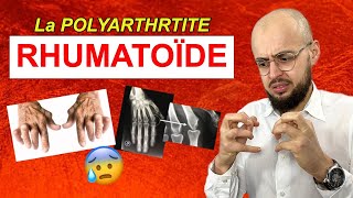 Les symptômes de la POLYARTHRITE RHUMATOÏDE [upl. by Nnazil988]