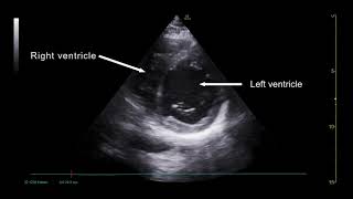 PoCUS Echo  Parasternal Short Axis PSAX View [upl. by Aleta]