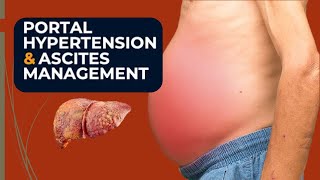 Portal HypertentionAscitesRefractory ascites managment Decompensated liver Complications [upl. by Northway772]