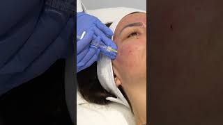 INNO CE® SCARS Application protocol by Dr Anna Tsebrovska scars innoce [upl. by Aura980]