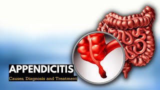 Appendicitis Causes Signs and Symptoms Diagnosis and Treatment [upl. by Wendt352]