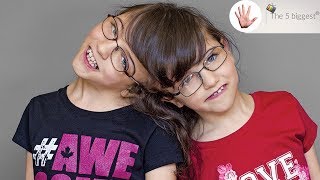 Do conjoined twins share thoughts Unbelievable facts  Body Bizarre [upl. by Lopes]