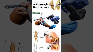 Arthroscopic Knee Surgery medical animation 3d short BiologywithAliya [upl. by Coveney975]