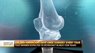 Joint Replacement Interview with Dr William Kurtz [upl. by Ihp]