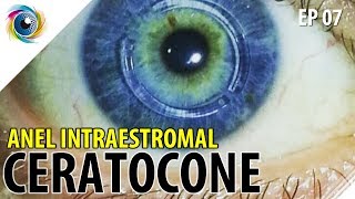 A cirurgia de anel intraestromal para o CERATOCONE  EP07  CheckUp dos Olhos [upl. by Carley]