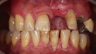 Endodontic treatment dental avulsion PRGF and temporary 3d printed bridge [upl. by Sorips194]