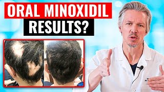 20000 PEOPLE TOOK ORAL MINOXIDIL AND THIS HAPPENED [upl. by Immij]