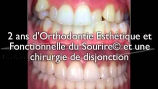 Disjonction chirurgicale jeune adulte  correction avec 2 ans daligneurs® en OEFS© sans extraction [upl. by Eenwahs41]