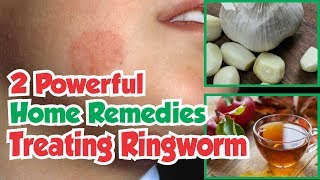 2 Powerful Home Remedies For Treating Ringworm [upl. by Tedra]