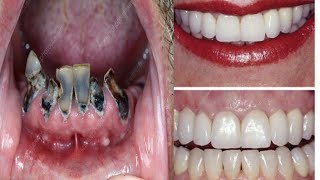 Dua Dental Clinic daharki teeth fitting method [upl. by Atikal740]