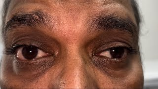 Myasthenia Gravis eye signs [upl. by Rainah925]