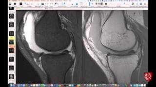 Knee MRI Supplemental Cases Part 2 [upl. by Michaella42]